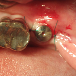 歯科インプラント術中写真