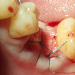 抜歯後の予防処置施術