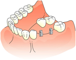 手術～人工歯の装着