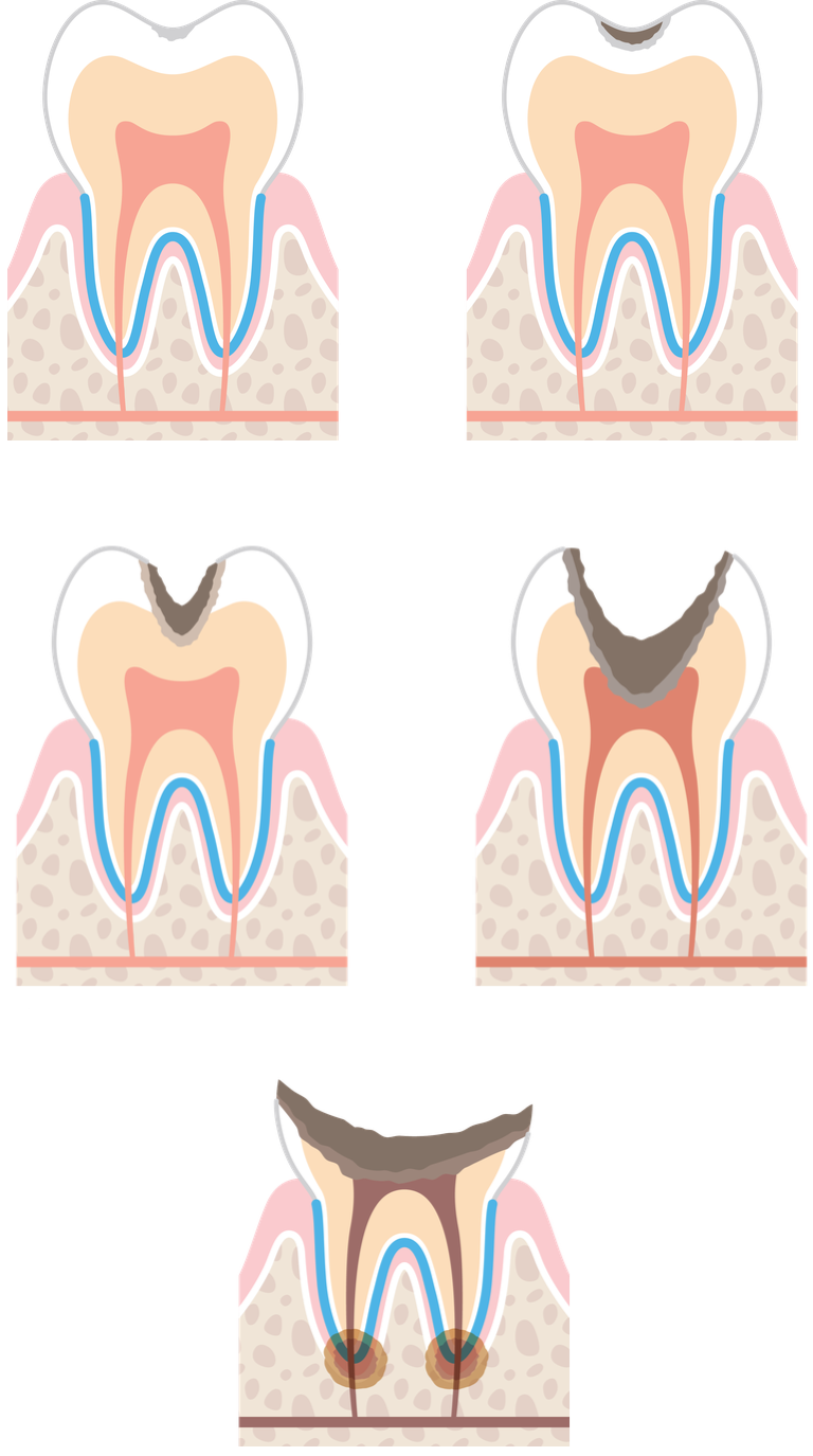 進行した虫歯の治療